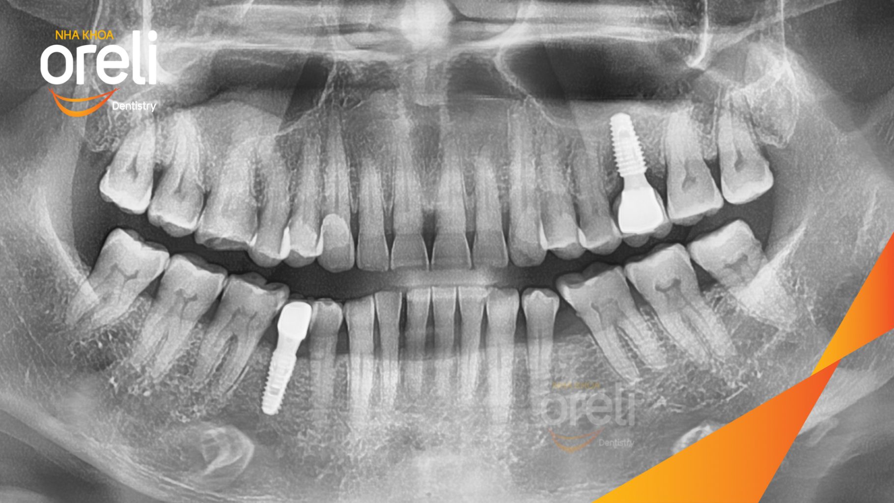 Thực hiện Cấy ghép trụ Implant chính hãng vào vùng mất răng kéo dài 3 tháng tại Oreli