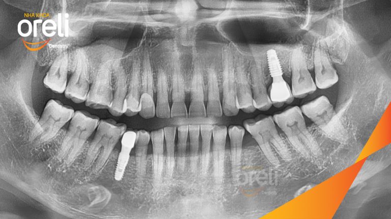 Ca Cấy Ghép Implant Hàm Dưới – Case thực tế tại Oreli
