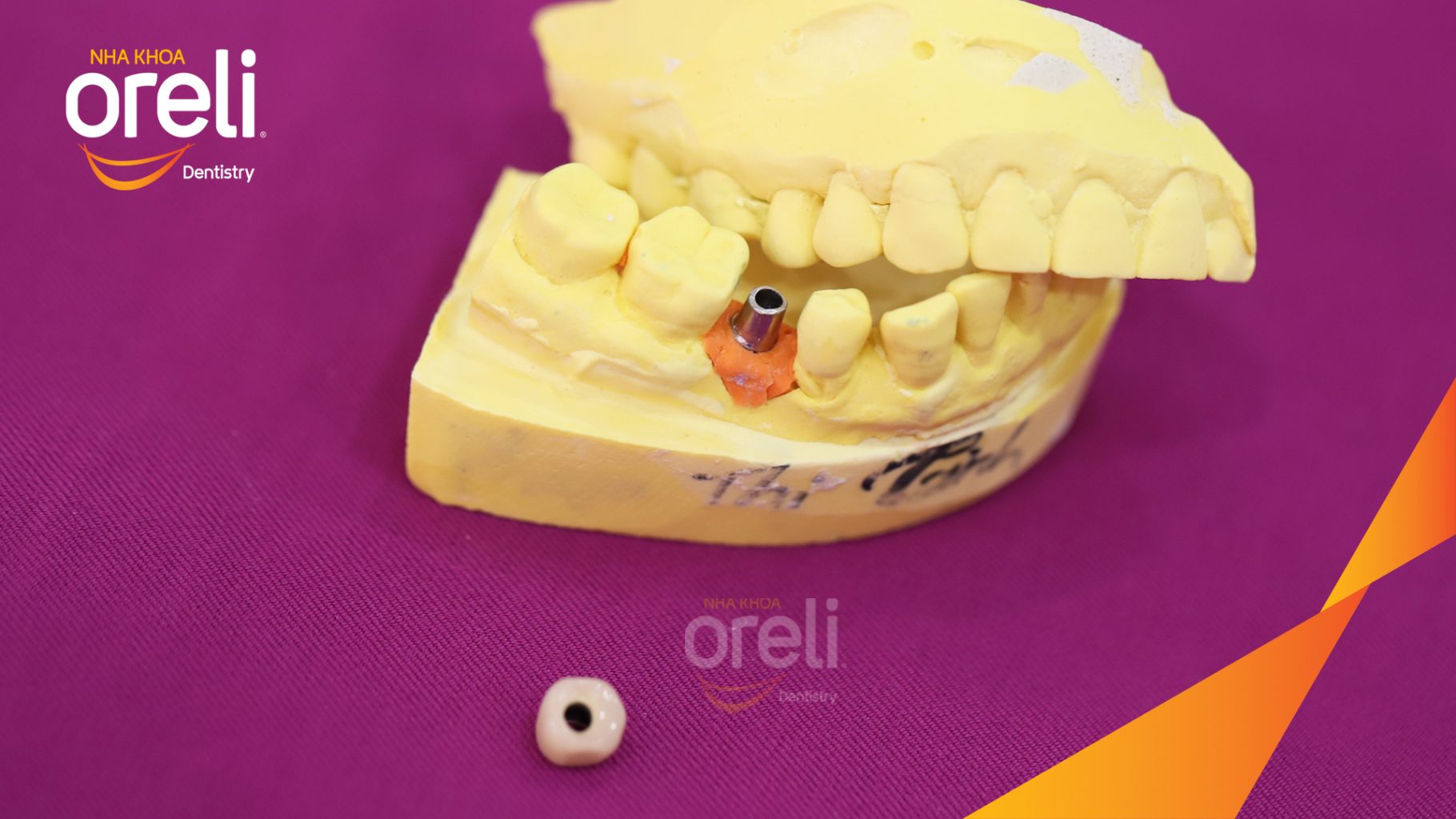 Kết quả sau 3 tháng: Hoàn thành đặt trụ Implant đúng vị trí mất răng tại Oreli