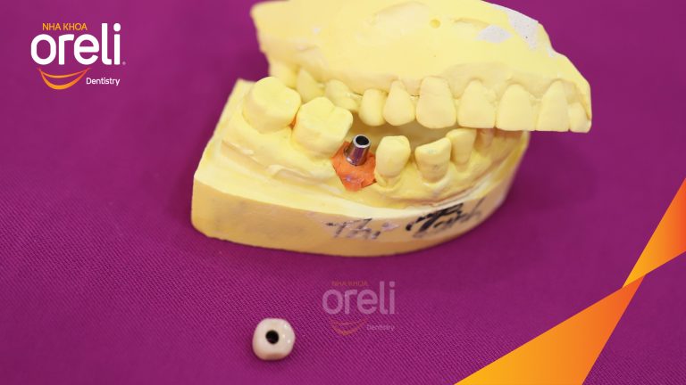 Ca Cấy Ghép Implant Hàm Dưới – Case thực tế tại Oreli