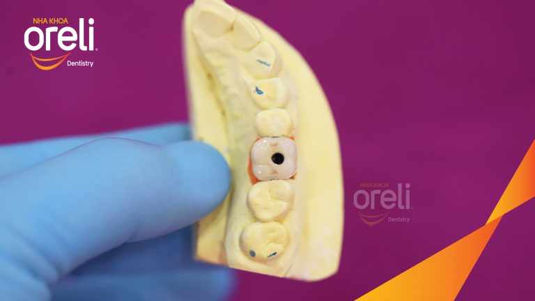 Ca Cấy Ghép Implant Hàm Dưới – Case thực tế tại Oreli
