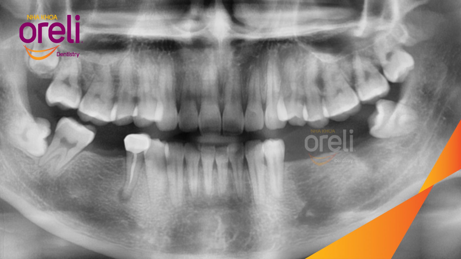 Trước điều trị: Mất răng hàm dưới tại Oreli