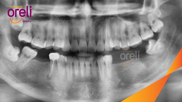 Ca Cấy Ghép Implant Hàm Dưới – Case thực tế tại Oreli