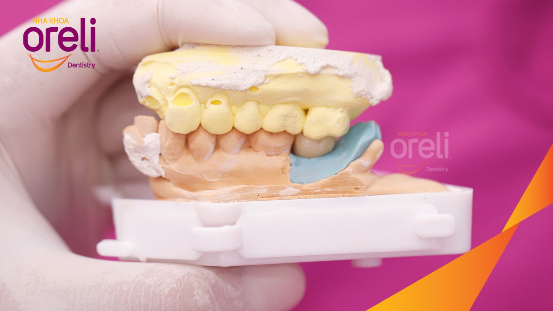 Quá trình Cấy ghép trụ Implant chính hãng vào vùng mất răng trong 3 tháng tại Oreli