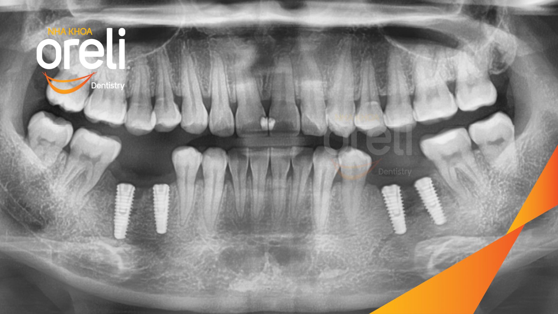 Mất 4 răng hàm dưới trước khi điều trị tại Oreli
