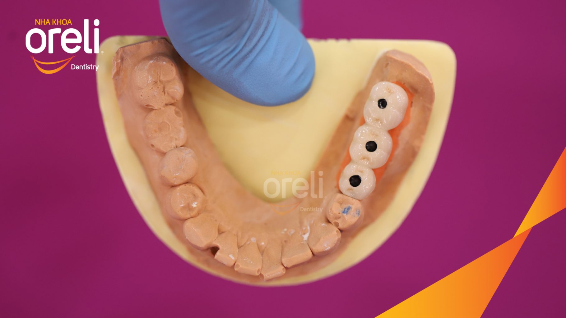 Thực hiện Cấy ghép trụ Implant chính hãng vào vùng mất răng kéo dài 3 tháng tại Oreli