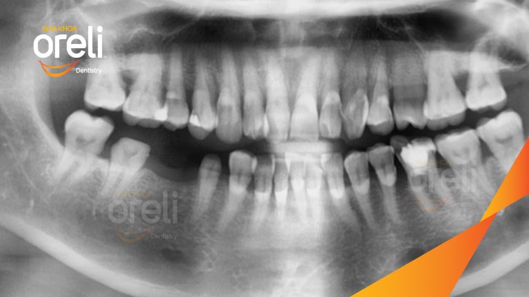 Ca Cấy Ghép Implant Hàm Dưới – Case thực tế tại Oreli