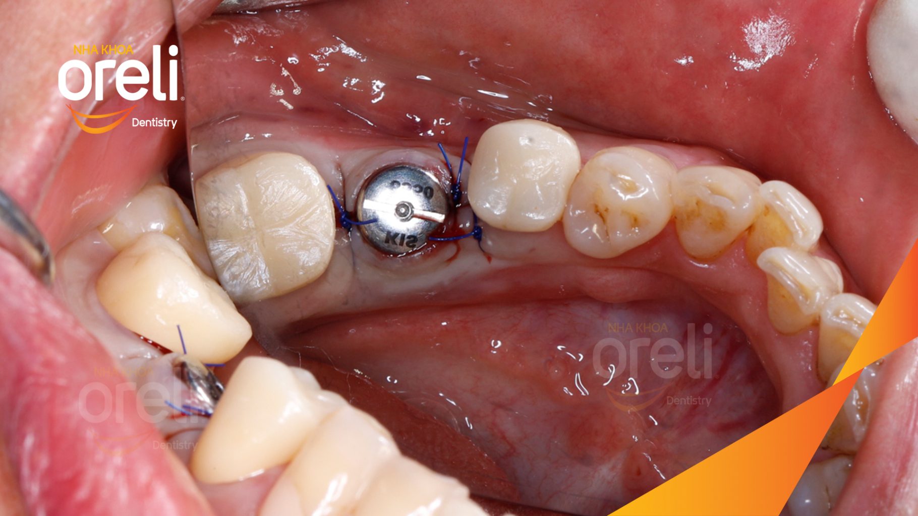 Kết quả sau 3 tháng: Hoàn thành đặt trụ Implant đúng vị trí mất răng tại Oreli