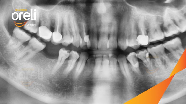 Ca Cấy Ghép Implant Hàm Dưới – Case thực tế tại Oreli