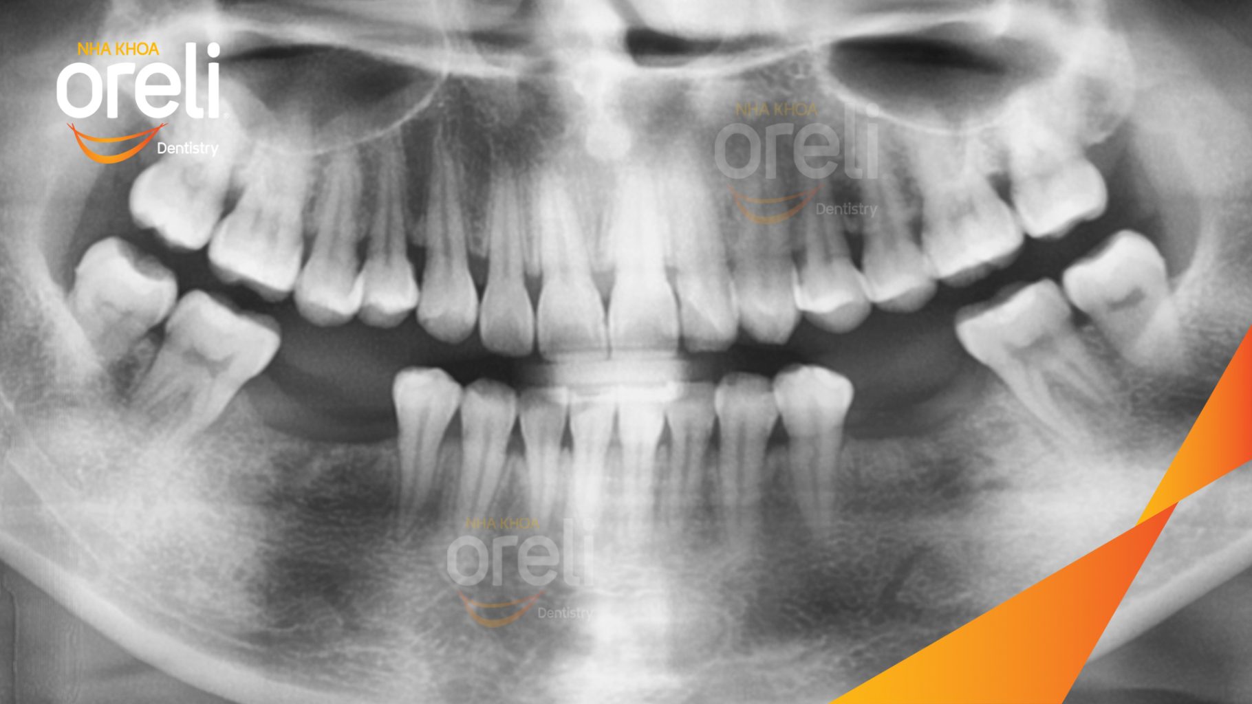 Trước điều trị: Mất 4 răng hàm dưới tại Oreli