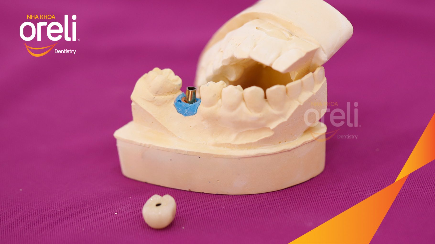 Kết quả đạt được sau 3 tháng - Phục hồi răng mất - ăn nhai chắc chắn và thẩm mỹ tự nhiên tại Oreli