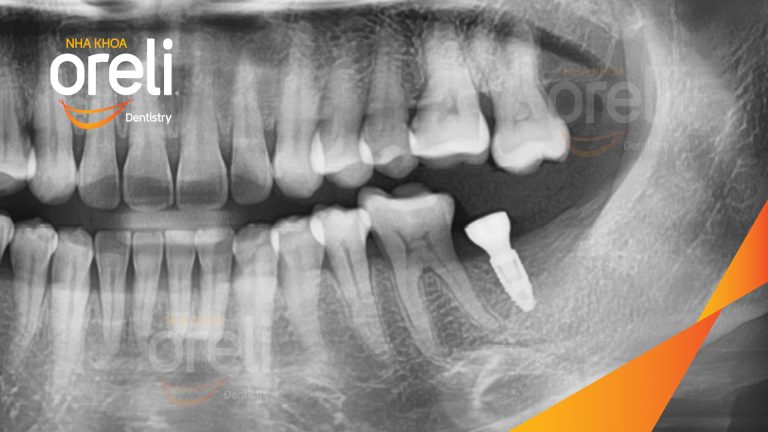 Ca Cấy Ghép Implant Phục Hồi Răng Tại Nha Khoa Oreli