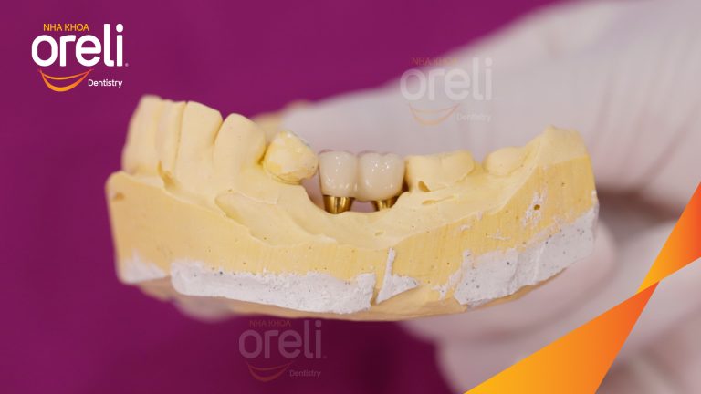 Ca Cấy Ghép Implant Hàm Dưới – Case thực tế tại Oreli
