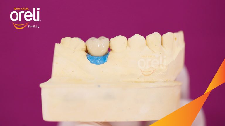 Ca Cấy Ghép Implant Phục Hồi Răng Tại Nha Khoa Oreli