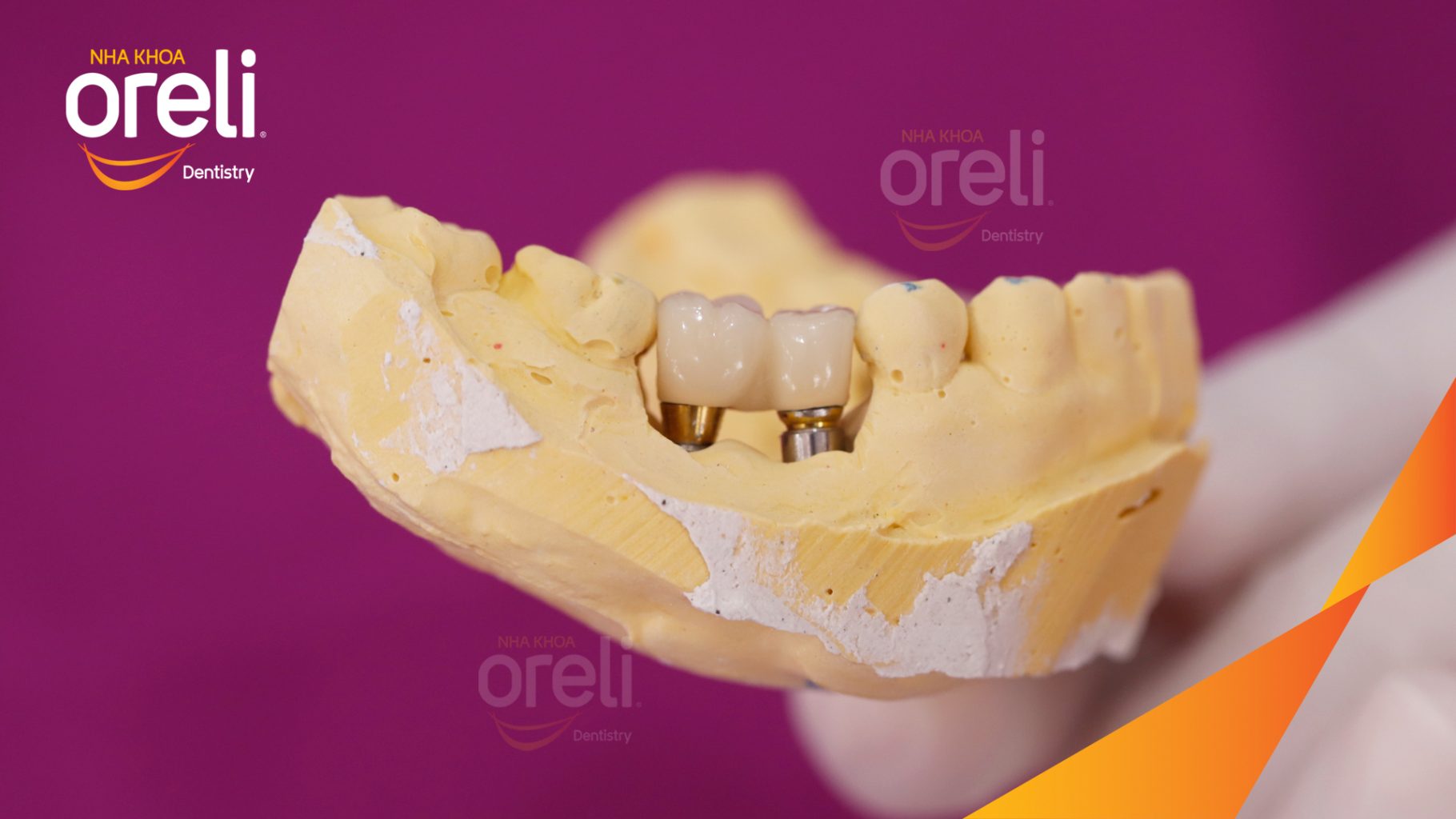 Trước điều trị: Mất 4 răng hàm dưới tại Oreli