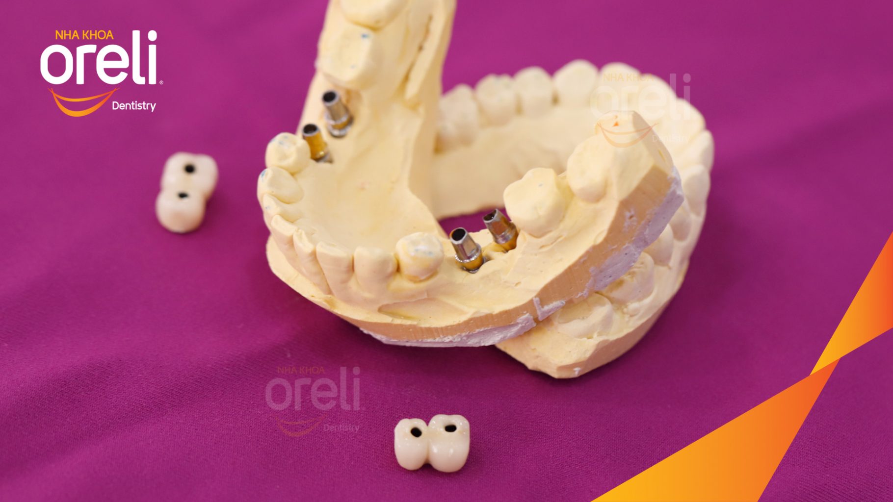 Thực hiện Cấy ghép trụ Implant chính hãng vào vùng mất răng kéo dài 3 tháng tại Oreli