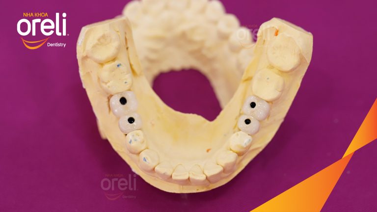Ca Cấy Ghép Implant Hàm Dưới – Case thực tế tại Oreli
