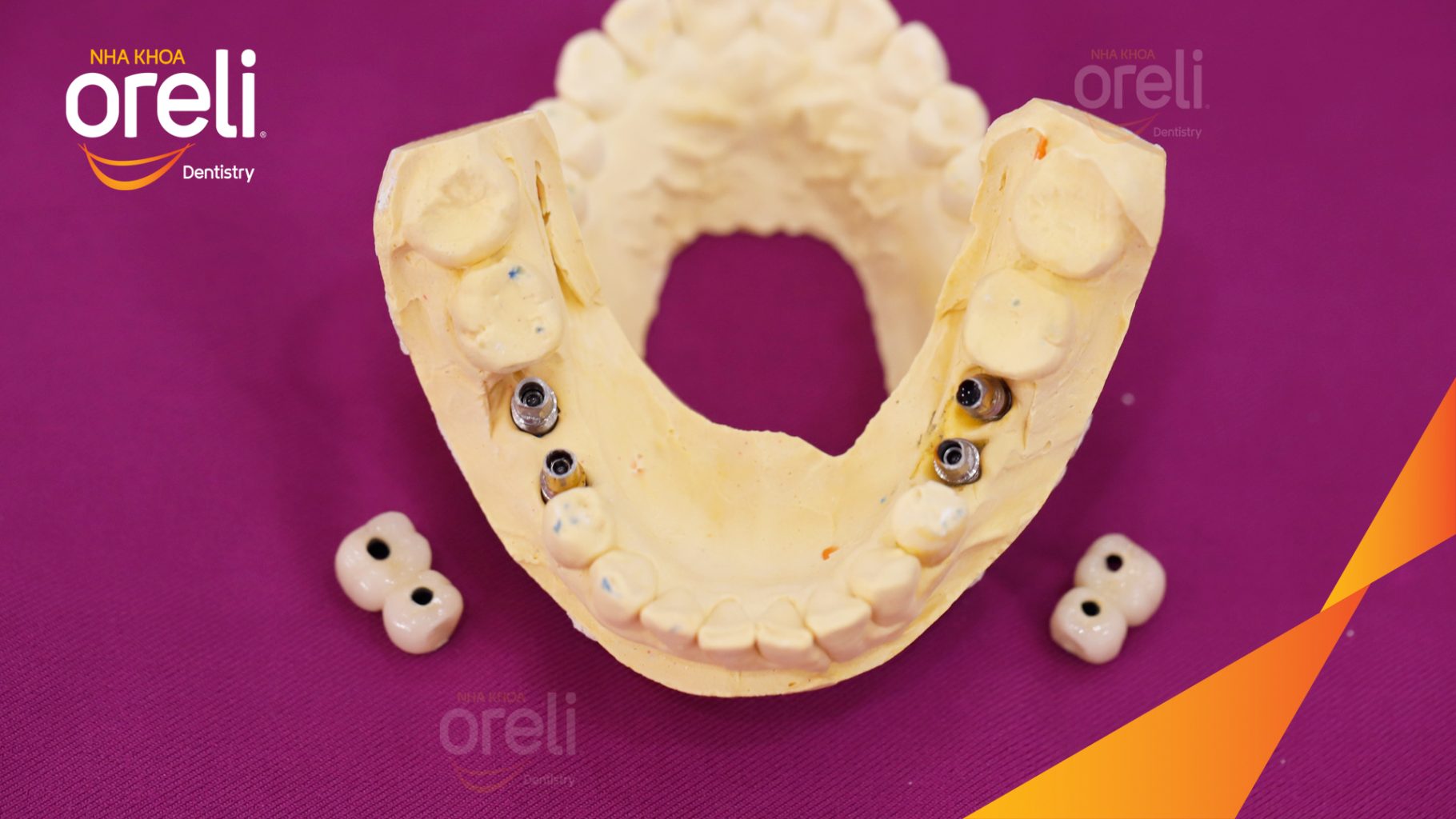 Kết quả sau 3 tháng: Phục hồi răng mất - ăn nhai chắc chắn và cười nói tự tin tại Oreli