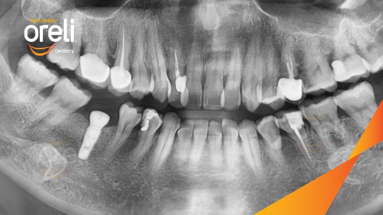Ca Cấy Ghép Implant Hàm Dưới – Case thực tế tại Oreli