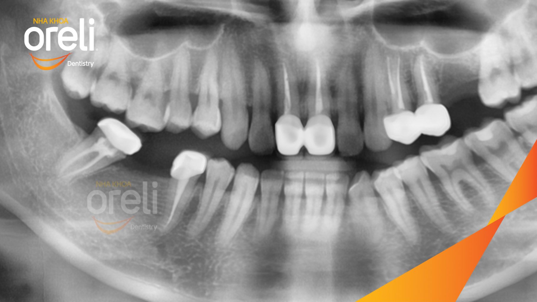 Trước điều trị: Mất răng hàm dưới tại Oreli