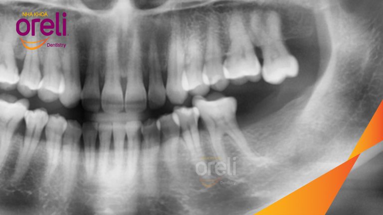 Ca Cấy Ghép Implant Phục Hồi Răng Tại Nha Khoa Oreli