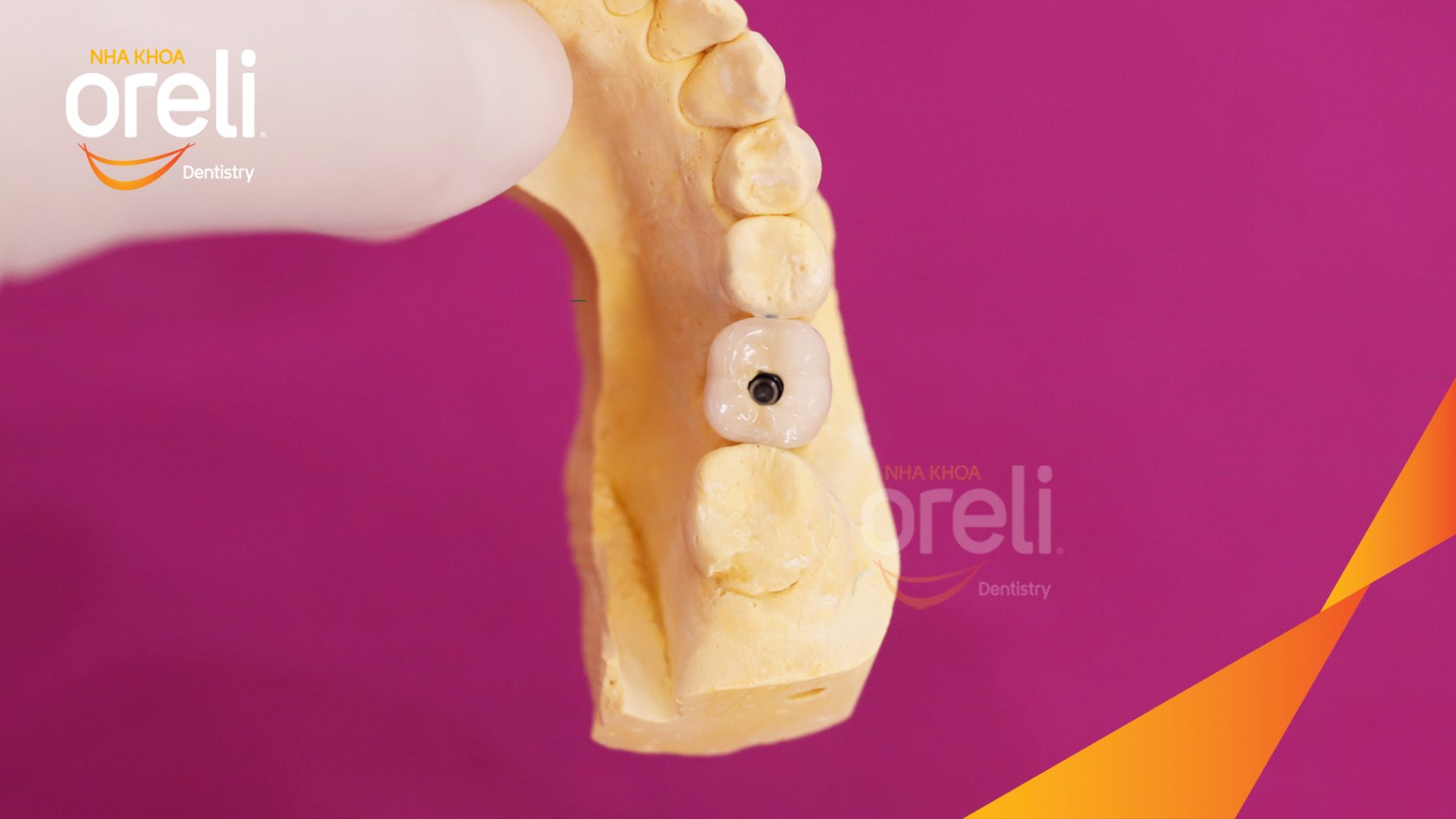 Kết quả đạt được sau 3 tháng - Hoàn thành đặt trụ Implant đúng vị trí mất răng tại Oreli