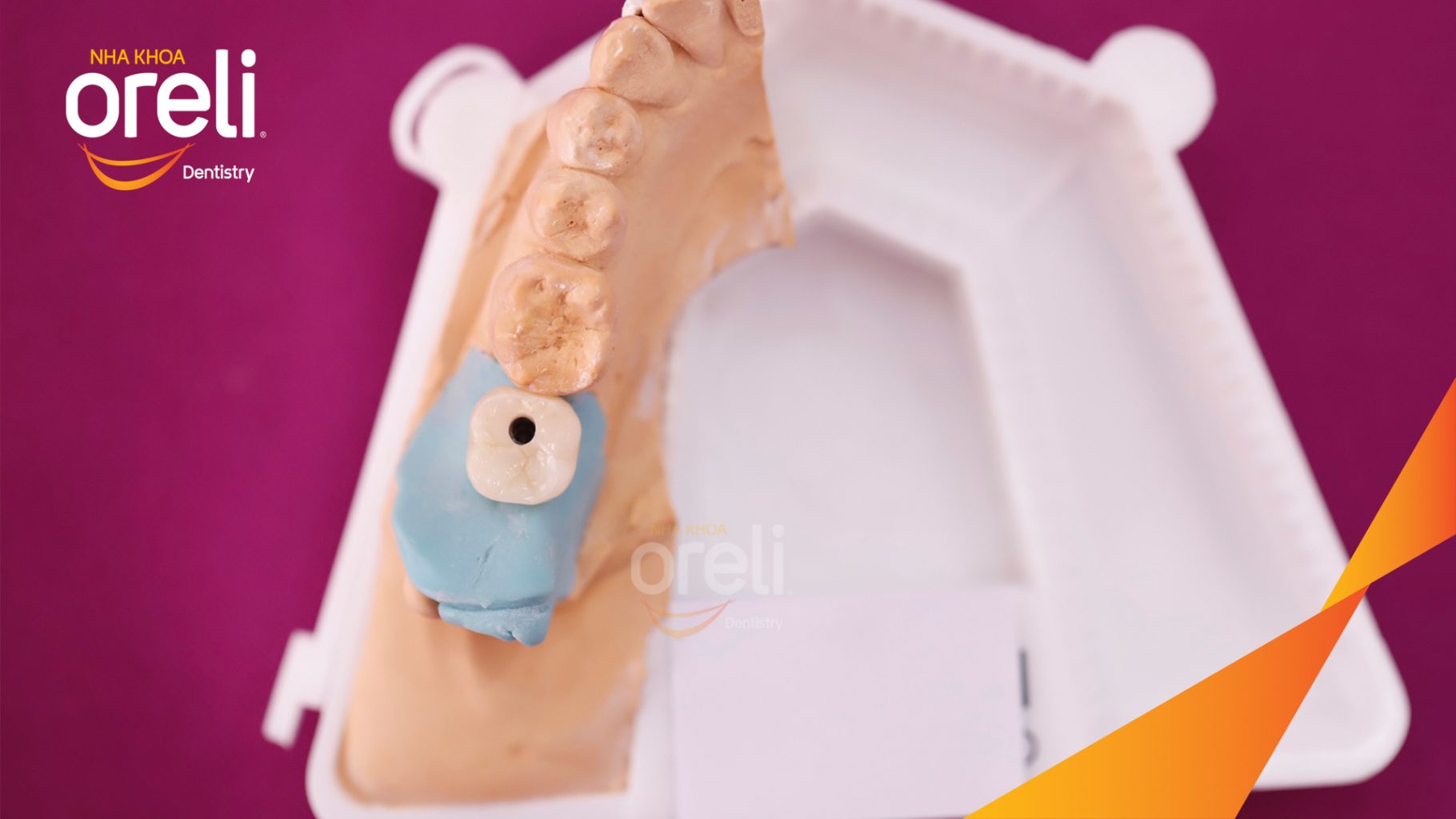 Thực hiện Cấy ghép trụ Implant chính hãng vào vùng mất răng kéo dài 3 tháng tại Oreli