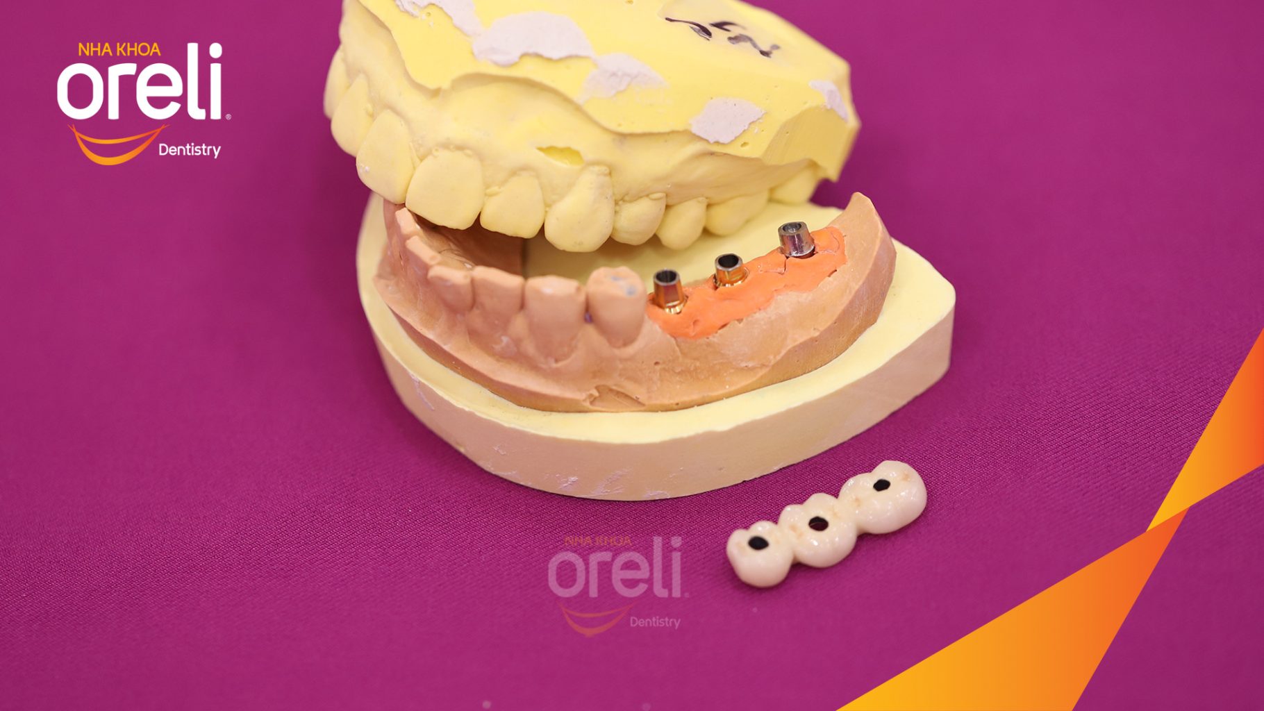 Quá trình Cấy ghép trụ Implant chính hãng vào vùng mất răng trong 3 tháng tại Oreli