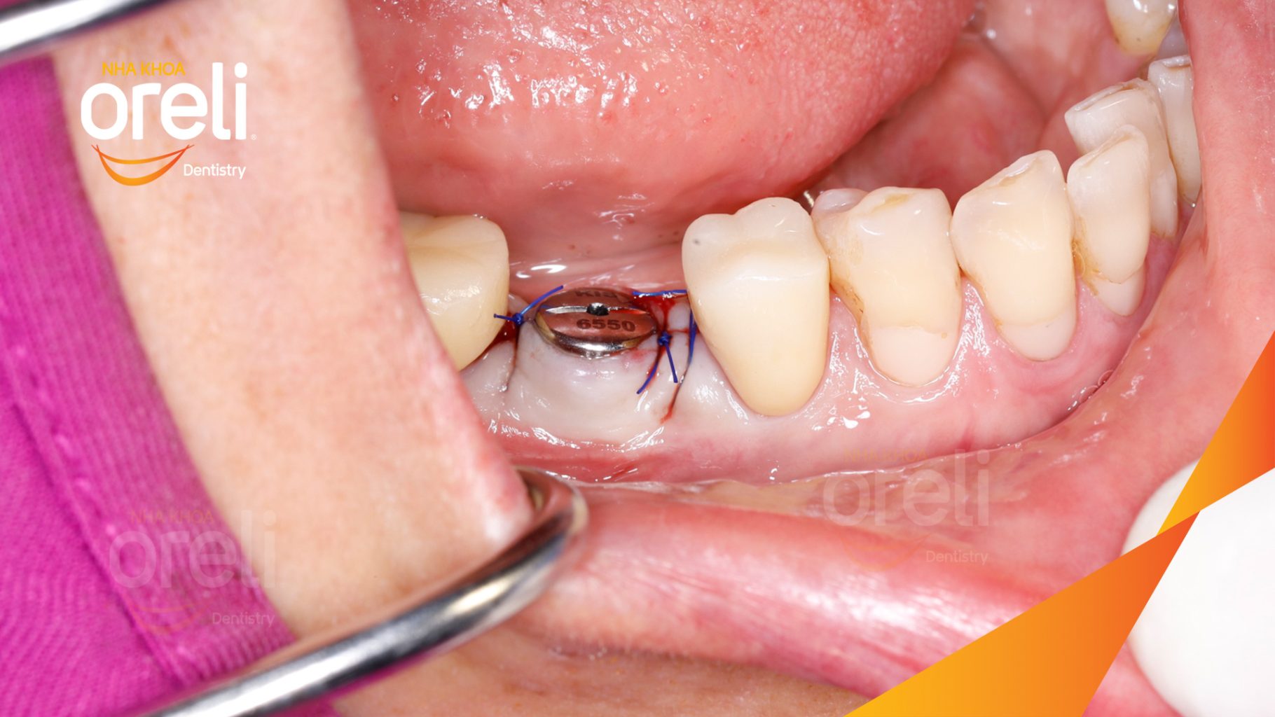 Quá trình Cấy ghép trụ Implant chính hãng vào vùng mất răng trong 3 tháng tại Oreli