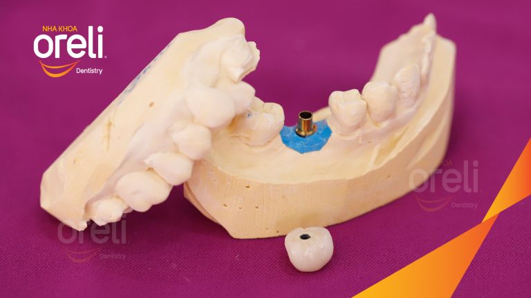Ca Cấy Ghép Implant Hàm Dưới – Case thực tế tại Oreli