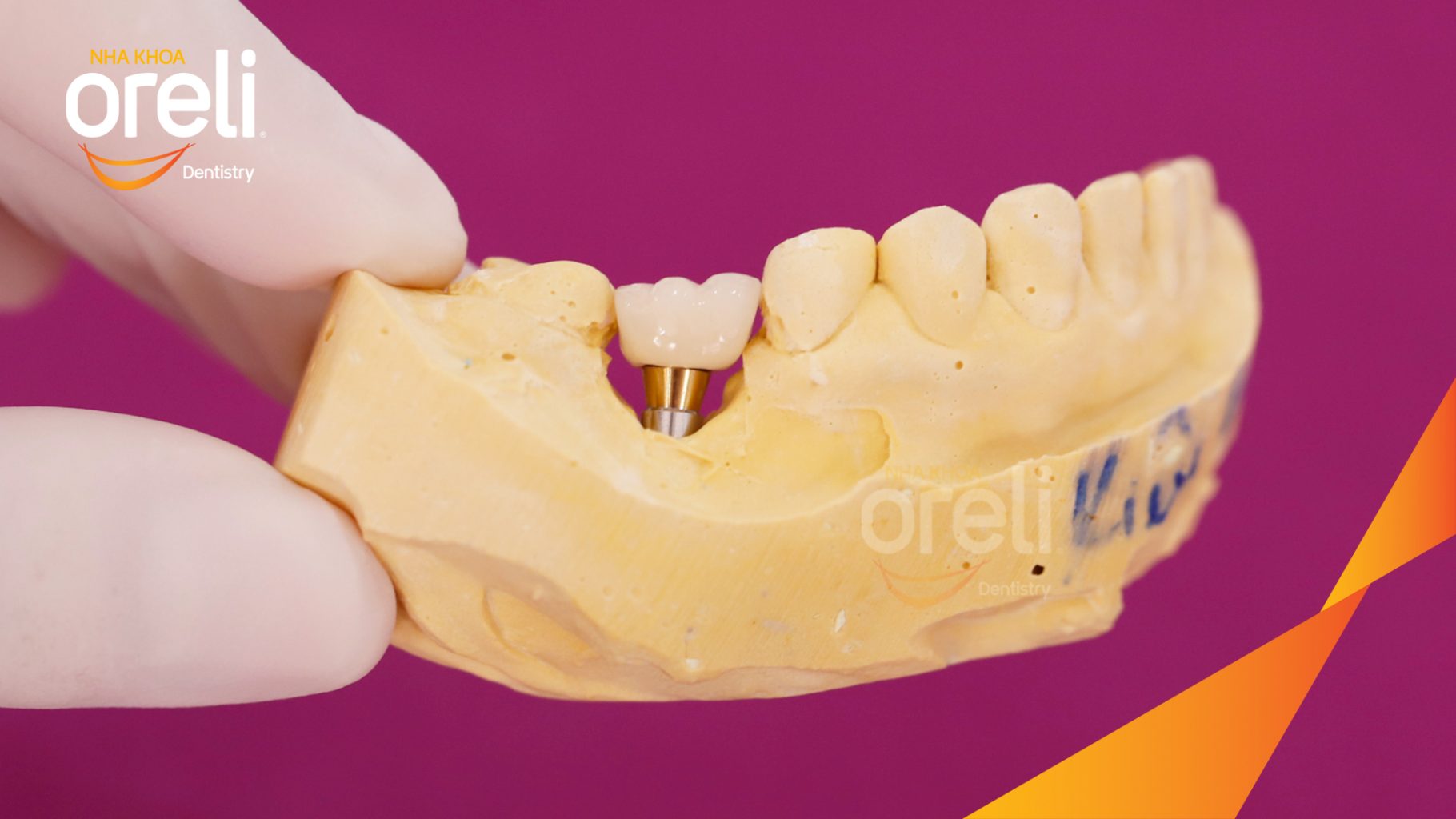 Thực hiện Cấy ghép trụ Implant chính hãng vào vùng mất răng kéo dài 3 tháng tại Oreli