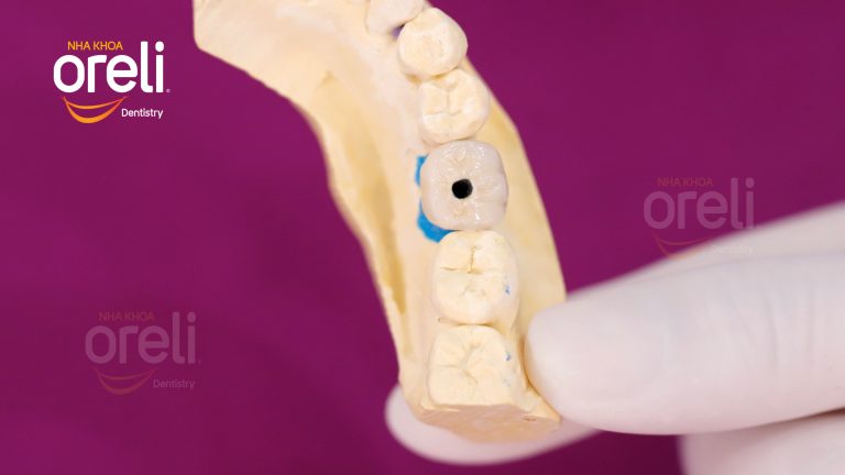 Ca Cấy Ghép Implant Hàm Dưới – Case thực tế tại Oreli
