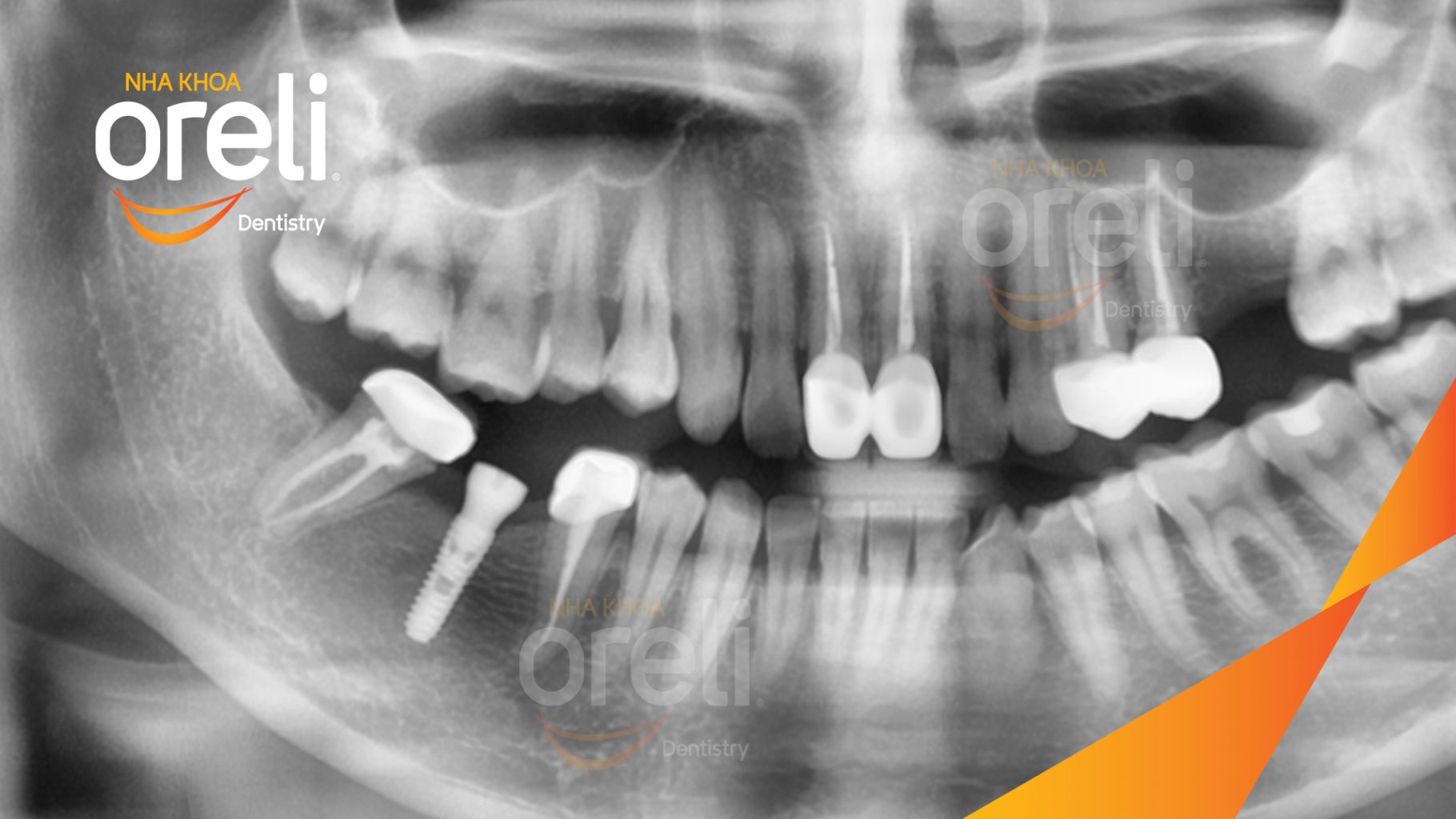 Mất răng hàm dưới trước khi điều trị tại Oreli