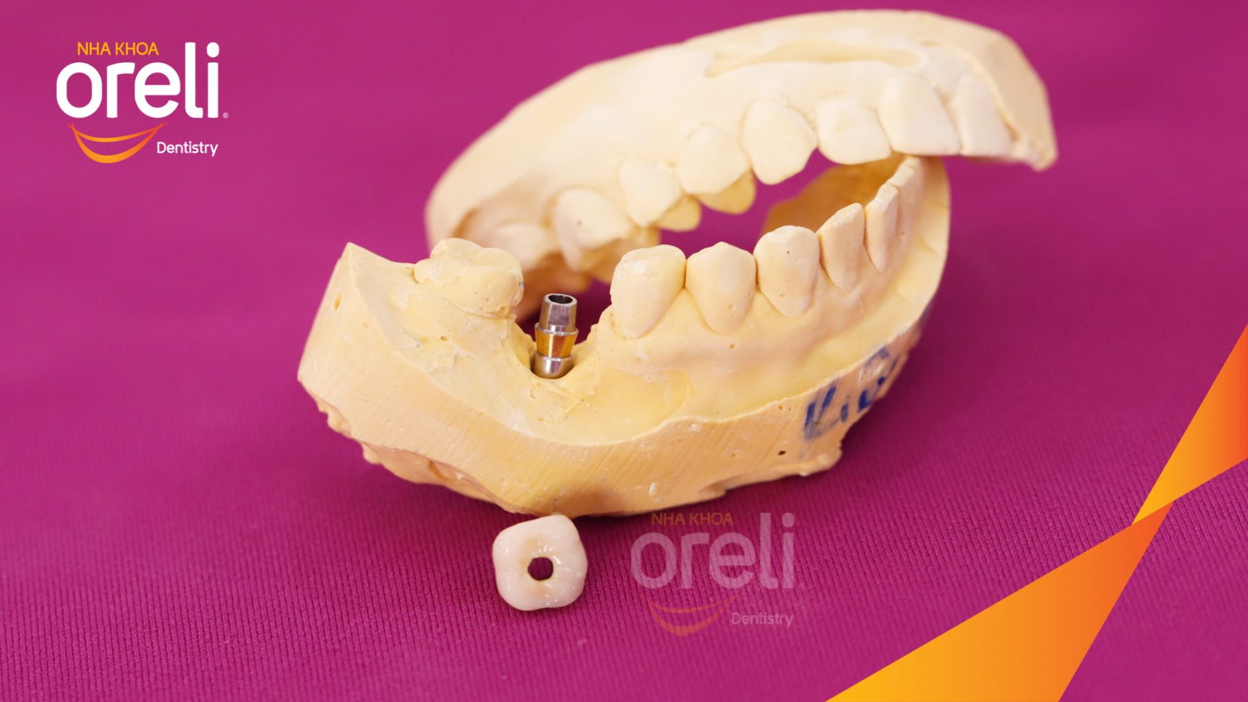 Kết quả sau 3 tháng: Hoàn thành đặt trụ Implant đúng vị trí mất răng tại Oreli