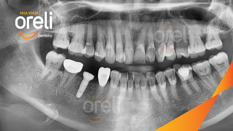 Ca Cấy Ghép Implant Hàm Dưới – Case thực tế tại Oreli
