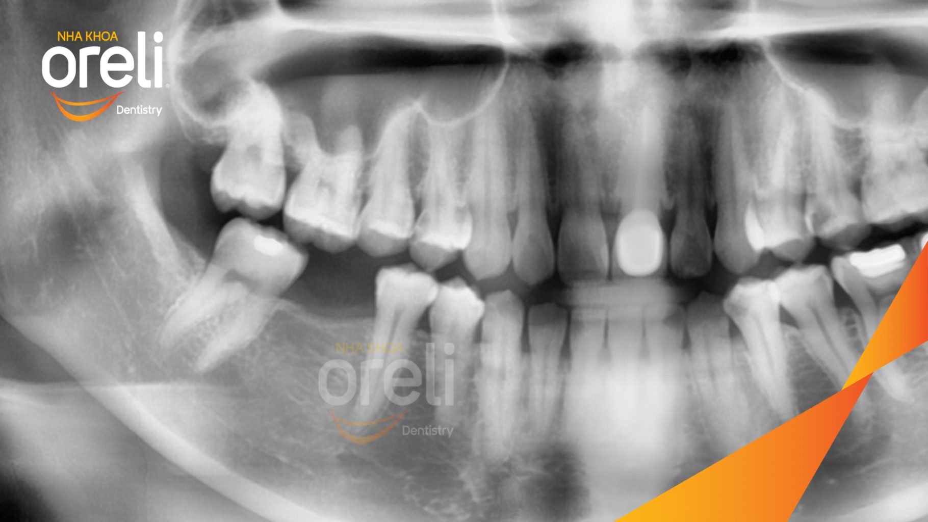 Trước điều trị: Mất răng hàm dưới tại Oreli