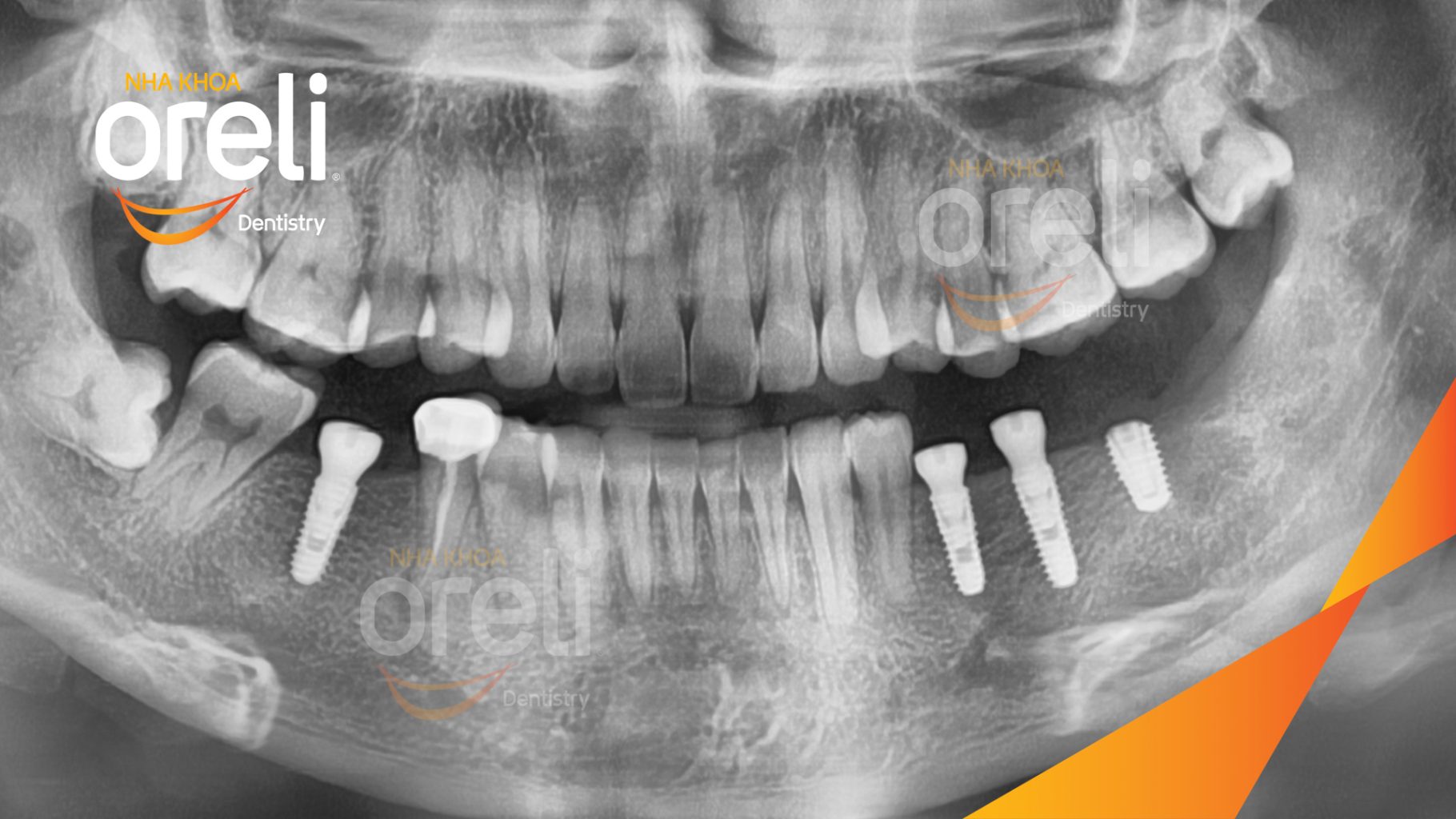 Mất răng hàm dưới trước khi điều trị tại Oreli