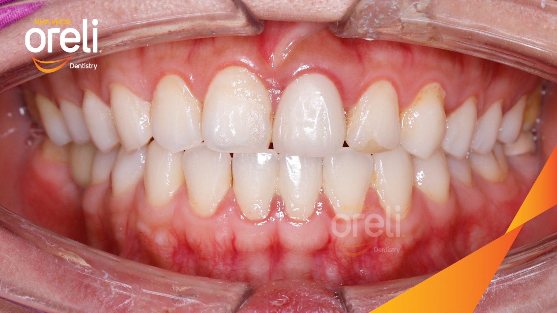 Trước điều trị: Mất răng hàm dưới tại Oreli