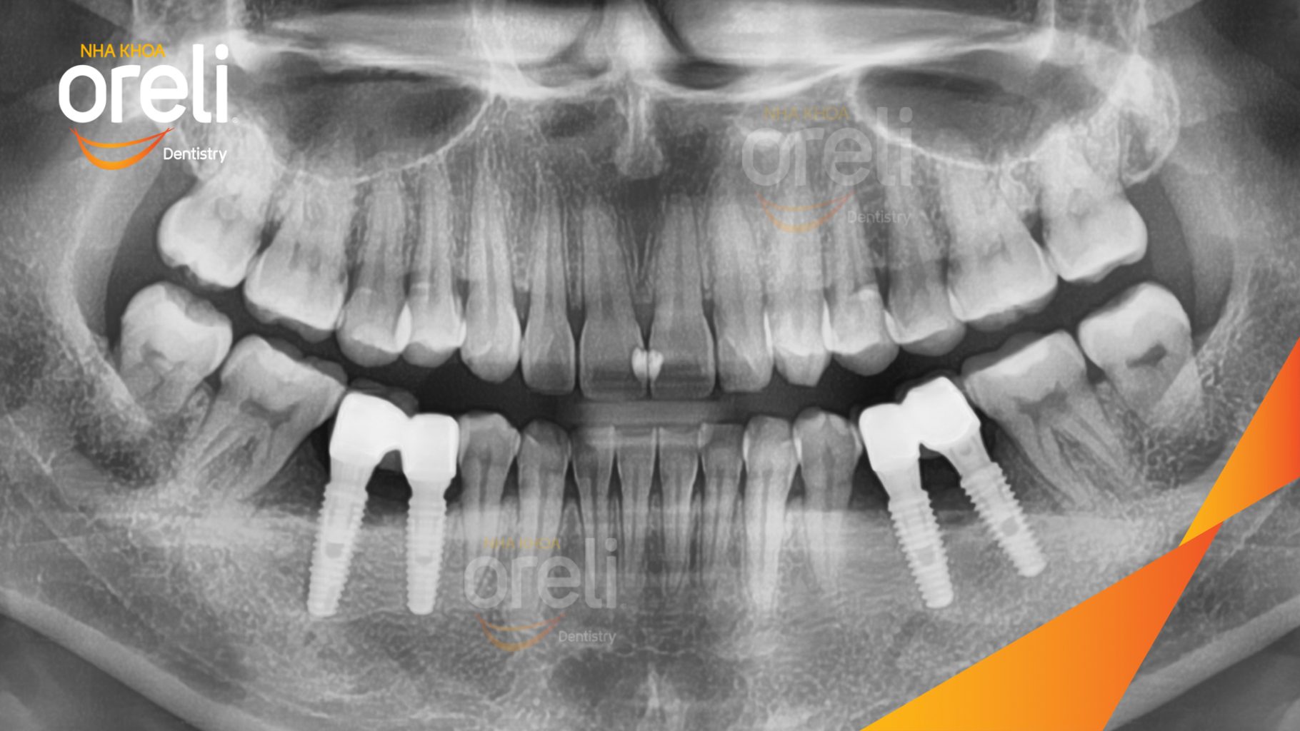 Quá trình Cấy ghép trụ Implant chính hãng vào vùng mất răng trong 3 tháng tại Oreli