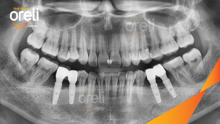 Ca Cấy Ghép Implant Hàm Dưới – Case thực tế tại Oreli