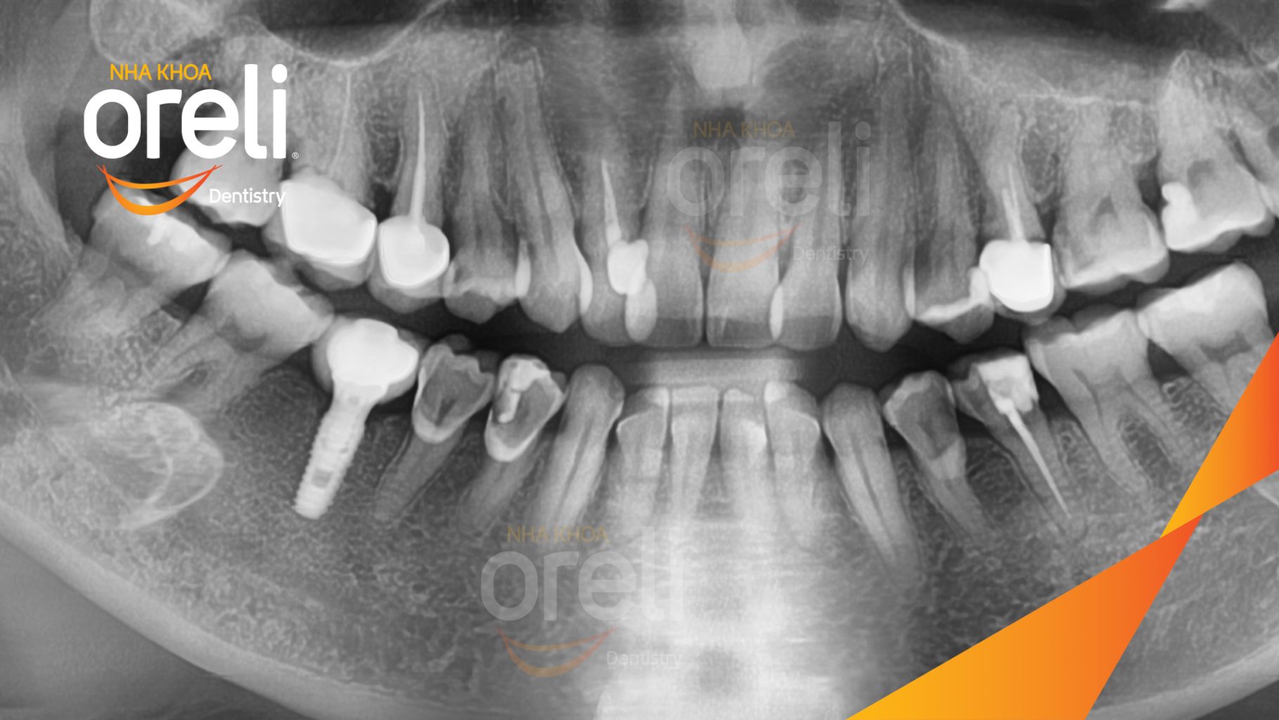 Quá trình Cấy ghép trụ Implant chính hãng vào vùng mất răng trong 3 tháng tại Oreli