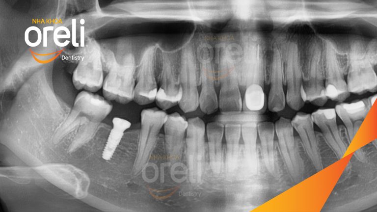 Ca Cấy Ghép Implant Phục Hồi Răng Tại Nha Khoa Oreli