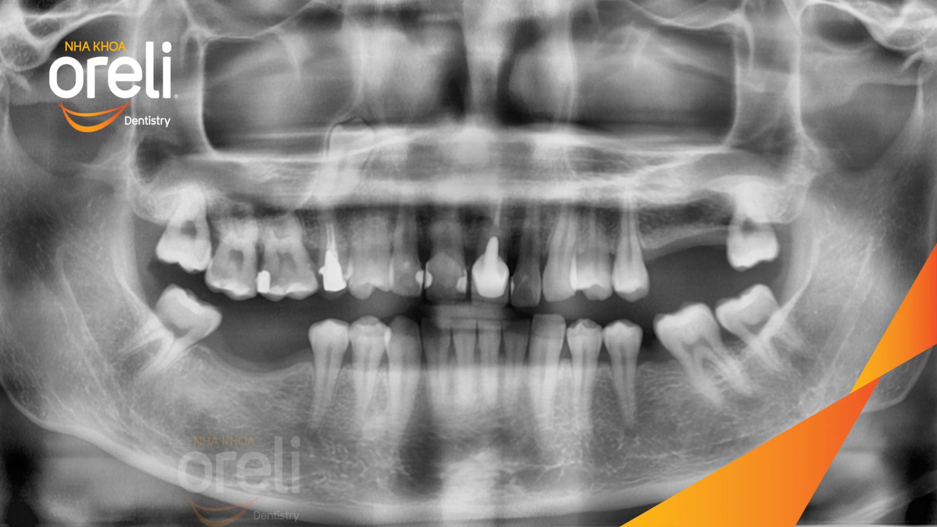 Trước điều trị: Mất răng hàm trên và dưới tại Oreli
