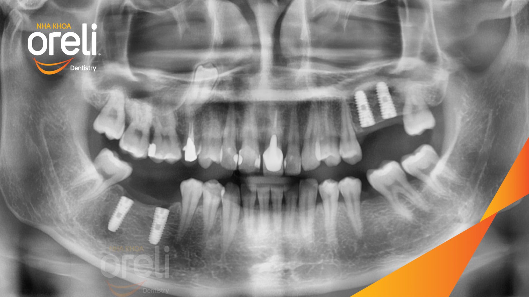 Mất răng hàm trên và dưới trước khi điều trị tại Oreli