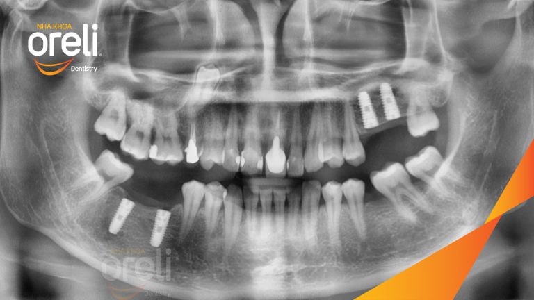 Ca Cấy Ghép Implant Phục Hồi Răng Mất Tại Nha Khoa Oreli