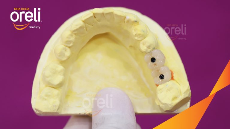 Ca Cấy Ghép Implant Phục Hồi Răng Mất Tại Nha Khoa Oreli