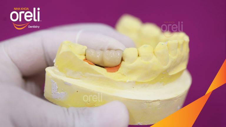 Ca Cấy Ghép Implant Phục Hồi Răng Mất Tại Nha Khoa Oreli
