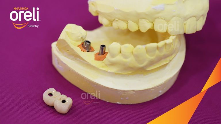 Ca Cấy Ghép Implant Phục Hồi Răng Mất Tại Nha Khoa Oreli
