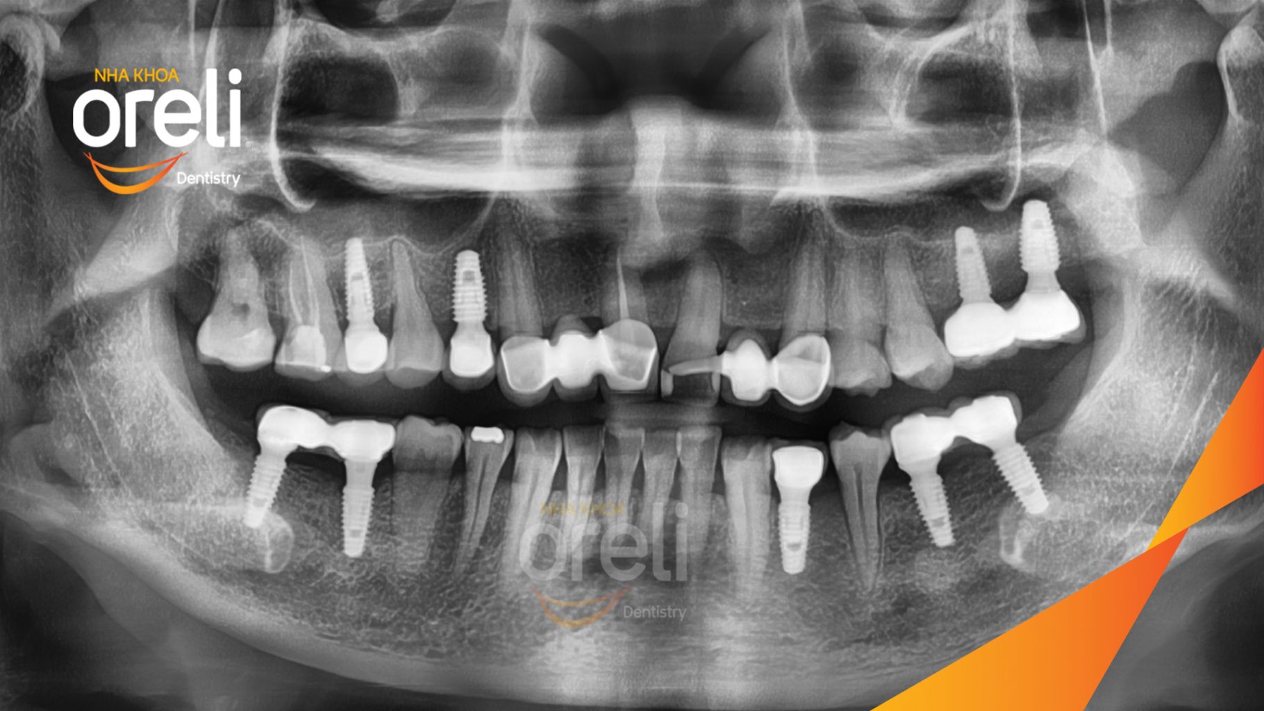 Mất răng hàm trên và dưới trước khi điều trị tại Oreli