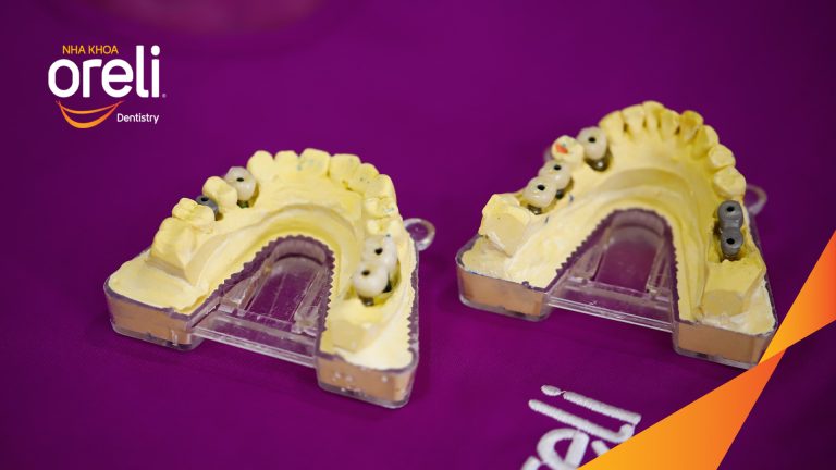 Ca Cấy Ghép Implant Hàm Dưới – Case thực tế tại Oreli